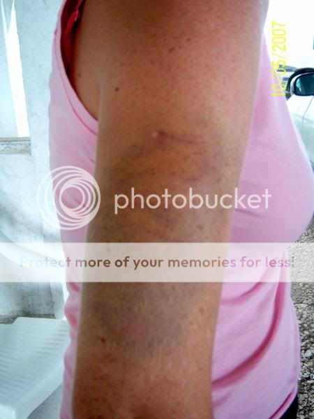 Bruise.jpg